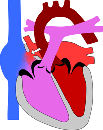 Atrium septum defect